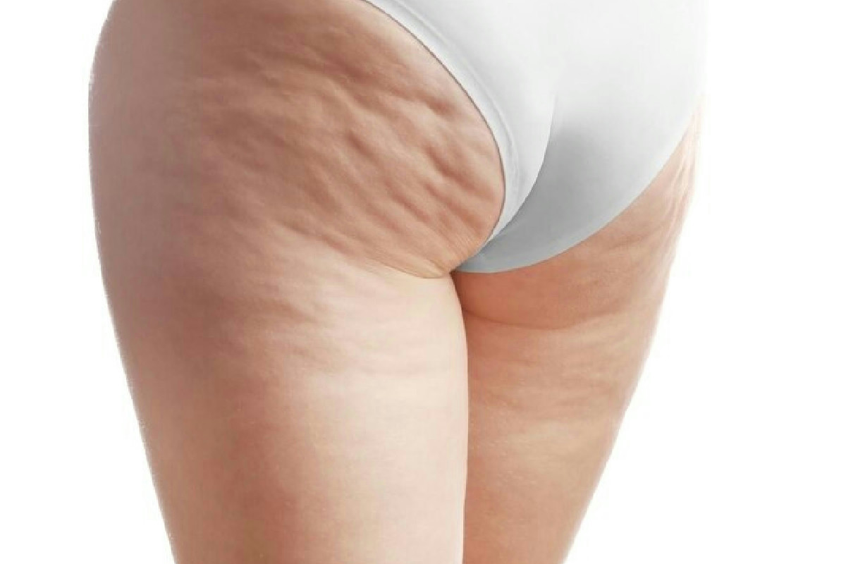 Sale e salumi peggiorano la buccia d’arancia: ecco perché eliminarli trasforma la pelle